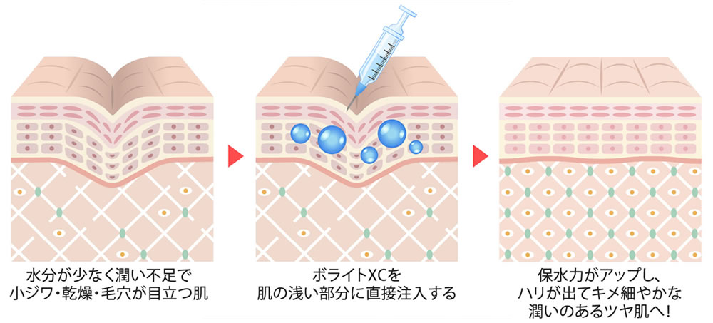 ジュビダームビスタ®ボライトXC